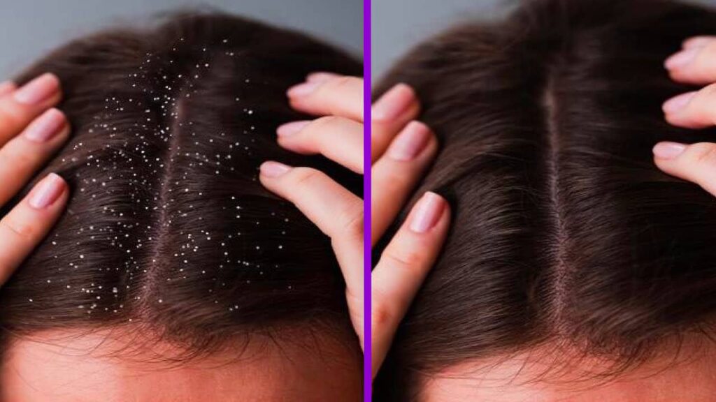Comment ne plus avoir de pellicules dans les cheveux ? Techniques et astuces efficaces !