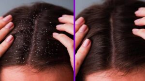 Comment ne plus avoir de pellicules dans les cheveux ? Techniques et astuces efficaces !