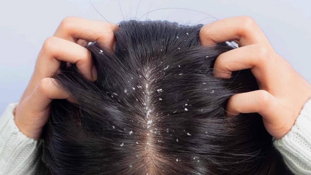 pellicules cheveux