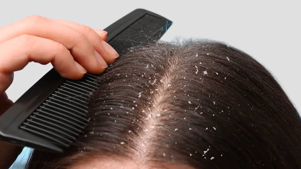 pellicules cheveux peigne